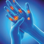 Arthritis 101: Symptoms, Causes, and Treatment Options