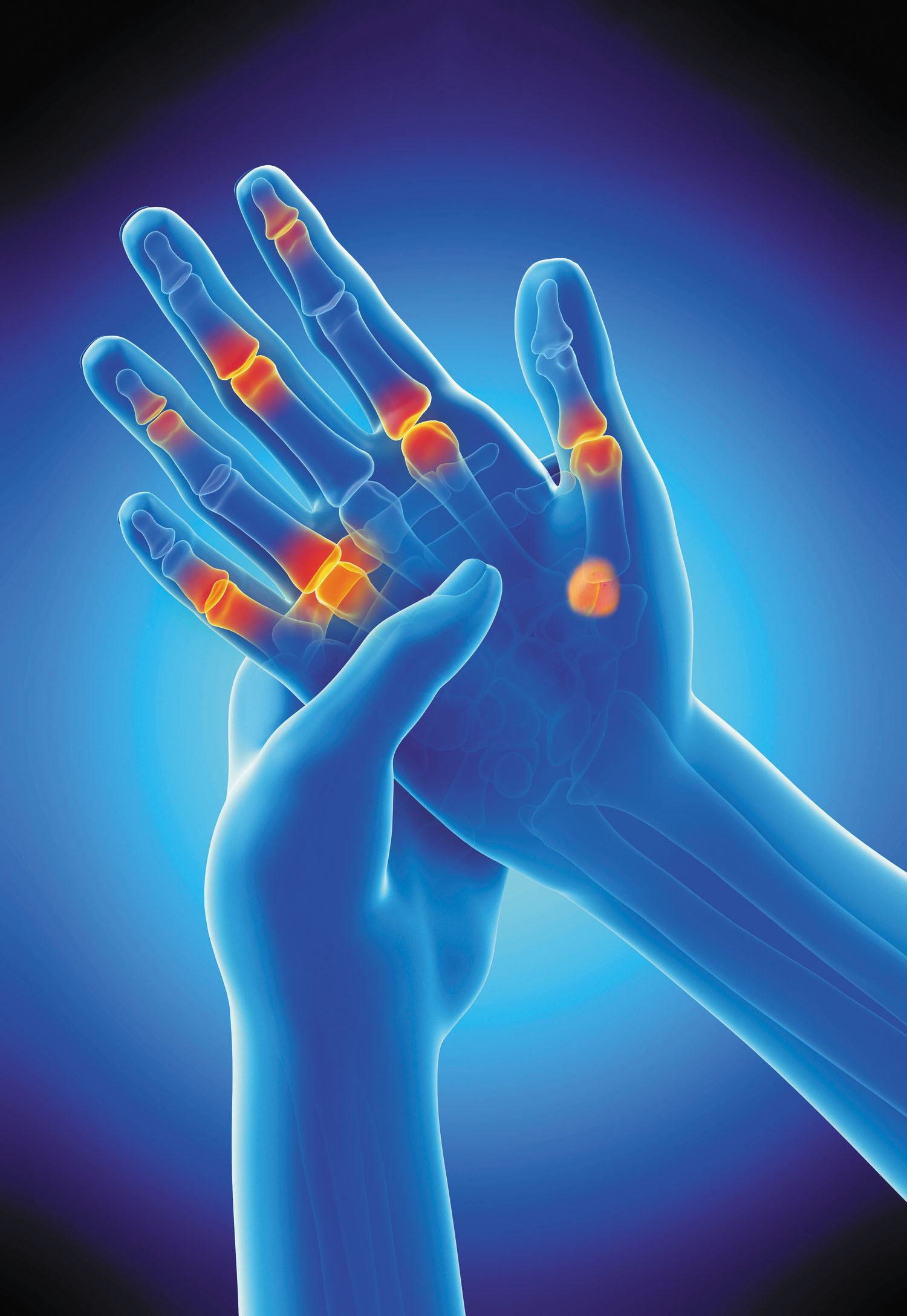 Arthritis 101: Symptoms, Causes, and Treatment Options